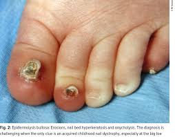 inherited nail diseases dermatologie