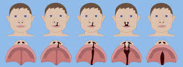 cleft lip and palate care