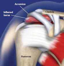 Citizens, both young and old. Subacromial Bursitis Central Coast Orthopedic Medical Group