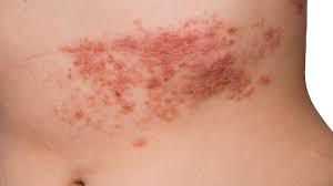 You can follow the remedies discussed below to soothe them and. What Is Poison Ivy Symptoms Causes Diagnosis Treatment And Prevention Everyday Health