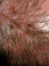 There's a wide variety of fungal infections that can affect your body. 10 Causes Of Hair Loss Hair Loss Center Everyday Health