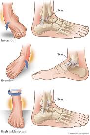 Best     Ankle sprain grades ideas on Pinterest   Ankle fracture     Dr  Axe