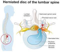 treatment for herniated disc premia