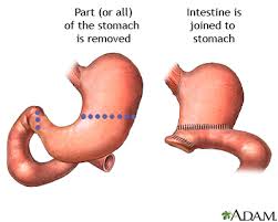 gastrectomy medlineplus cal