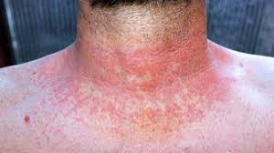 Fotos do rash da escarlatina | MD.Saúde