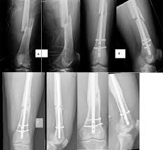 vitamin d in treatment of fracture