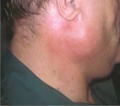 salivary gland swellings treatment in