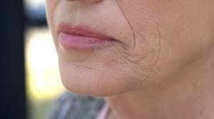 wrinkles around the mouth and how to
