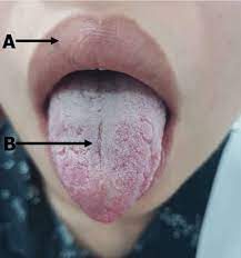 anterior central tongue furrow