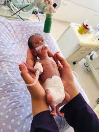 23 haftalıkken 520 gram doğan Nisa bebek 142 gün sonra hayata tutundu -  Takvim