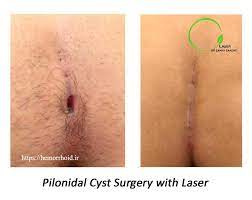 what is a pilonidal cyst dr zahra