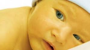Nguyên nhân và dấu hiệu vàng da ở trẻ sơ sinh