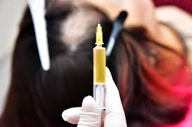 steroid injections for hair loss