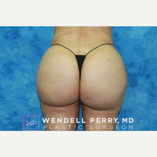At heights plastic surgery, we accept cash and all major credit cards. Brazilian Butt Lift Revision Worth It Reviews Cost Pictures Realself