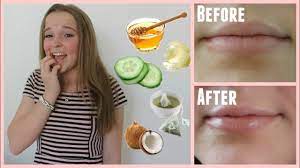 easy ways to cure chapped lips in