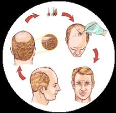 Umar's groundbreaking work on hair transplantation has not. Los Angeles Surgical Hair Replacement Therapy Directory
