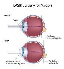 what is lasik eye surgery best eye