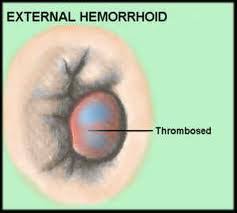 In the medical globe any hemorrhoid is actually referred to as any swollen spider vein within the rear end location. The Main Symptoms Of Hemorrhoids Health Care