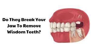 your jaw to remove wisdom teeth