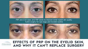 benefits of prp injection under eyes