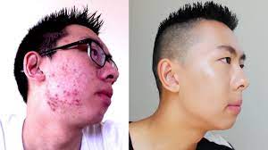 how to cover up acne mens makeup