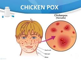 Study Medical Photos Chicken Pox Charts