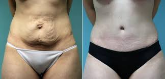 tummy tuck cost scar recovery