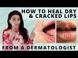 how to heal dry ed lips fast