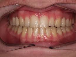 Here are some techniques that you can use to fix such gaps Before After Gallery Kingston Orthodontics We Create Smiles