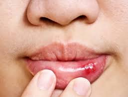 dental health and canker sores biolase
