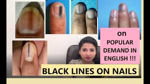 black lines on nails what to do mbbs