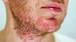 is it eczema on my face eczema