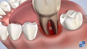 general tooth extraction post operative