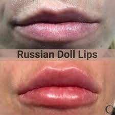 russian doll lip filler capizzi md