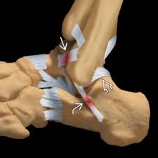 These symptoms can include popping, stiffness, buckling and pain. Ankle Sprain An Overview Sciencedirect Topics
