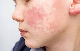 common kid skin rashes and