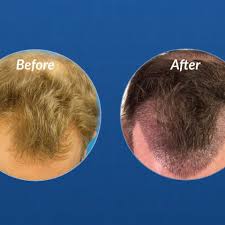 Hair growth chart after hair transplant. Stages Of Hair Transplant Growth See This Patient S Hair Grow After A Transplant