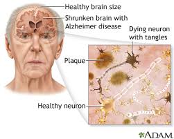 alzheimer disease medlineplus cal