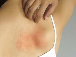 winter rash causes treatment and