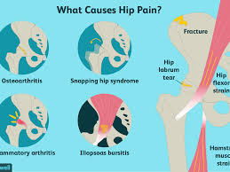 How long did he study for the job? Hip Pain Causes Treatment And When To See A Doctor