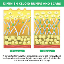 tobcharm keloid scar removal keloid