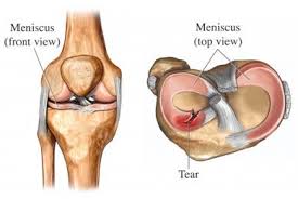 meniscus tear diffe treatment