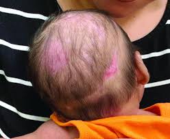 a 2 month old infant with a scalp rash
