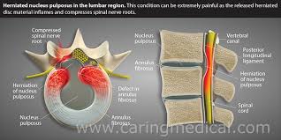 surgery for bulging or herniated disc