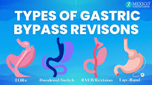 types of gastric byp revisions