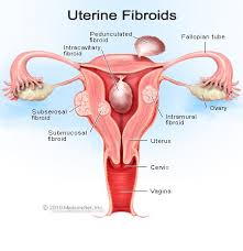 A word that expresses a meaning opposed to the meaning of another word, in which case the two words are antonyms of each other. Uterine Fibroids Causes Treatment Symptoms Diet Surgery