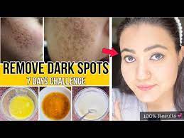 in 7 days remove dark spots acne