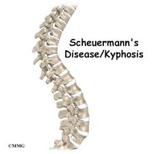 Scheuermann's kyphosis usually relatively inflexible on bending radiograph. Patient Education Concord Orthopaedics