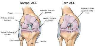 acl surgery recovery timeline