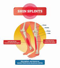 treat shin splints